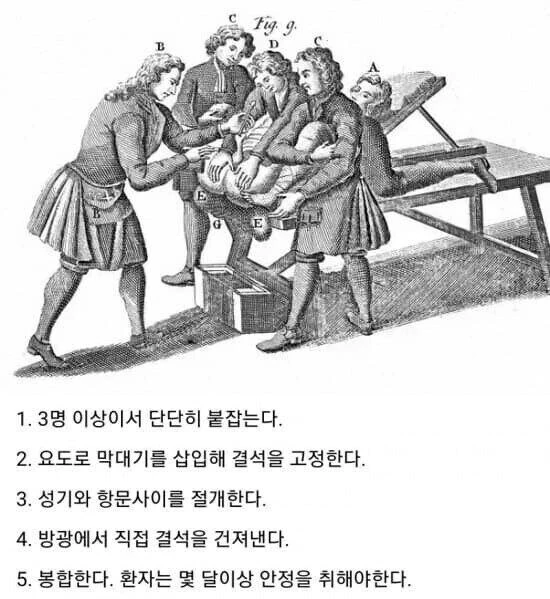 끔찍한 요로결석 치료법 jpg.